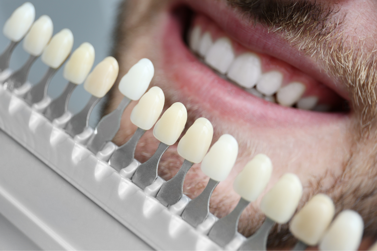 Different Types Of Dental Veneers