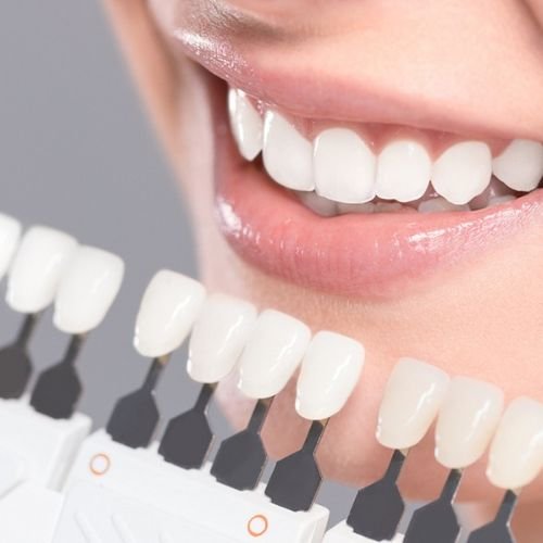 Porcelain vs Composite Veneers