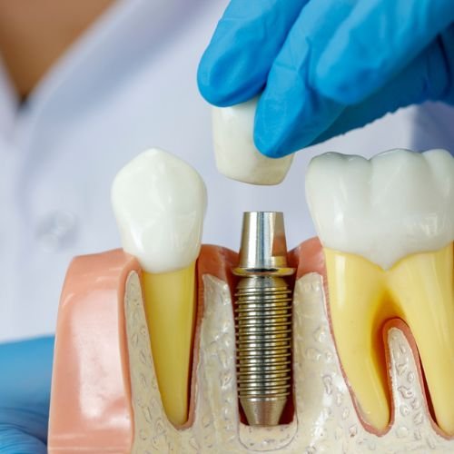 Dental Implants In Perth